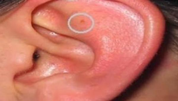 اكتشاف أول طريقة لمعرفة &quot;عذرية الرجال&quot;