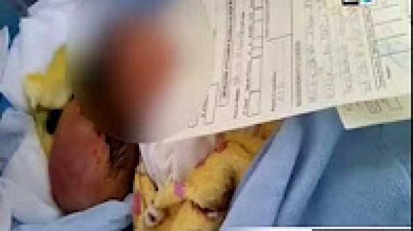 والد الطفلة التي وُلدت برأسين