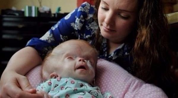 طفلة برأس متضخم تتحدى توقعات الأطباء