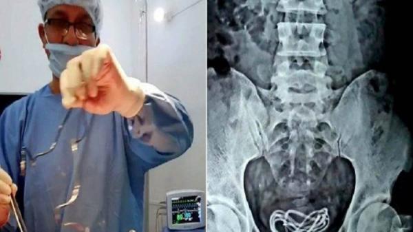 أغرب عملية جراحية.. إزالة شاحن هاتف طوله 60 سم من مثانة شاب