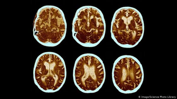 دراسة: هذا المزيج الغذائي يحد من آثار مرض الزهايمر