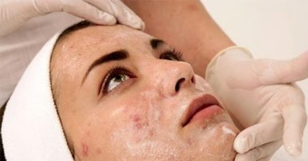 أربع طرق للتخلص من الرءوس السوداء