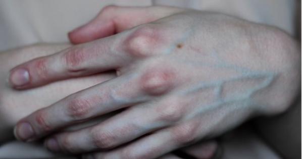 أسباب ظهور أوردة باللون الأخضر أو ​​الأزرق على البشرة