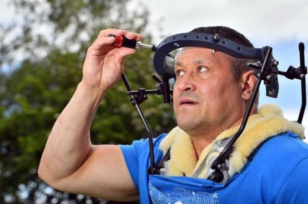 رجل يعيش مع حلقة معدنية ثبتها الأطباء حول جمجمته بعد سقوطه من فوق سور حديقة