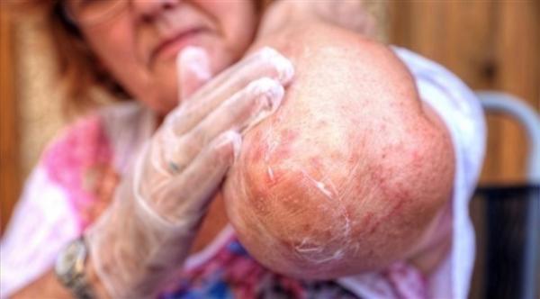 كيف يعالج مريض السكري مشاكل البشرة؟