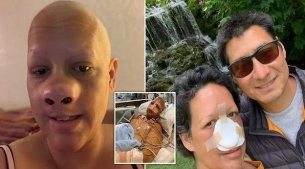 بريطانية تفقد أنفها بالكامل بعد اكتشافها بالصدفة الإصابة بالسرطان