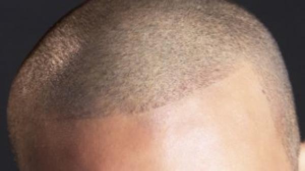 ثلاث طرق جديدة لزراعة الشعر