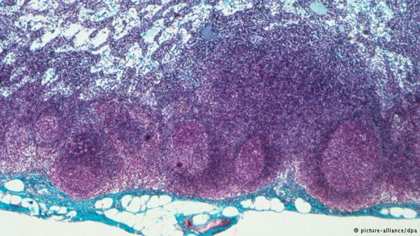 طرق جديدة لعلاج الوذمة اللمفية بالتدخل الجراحي