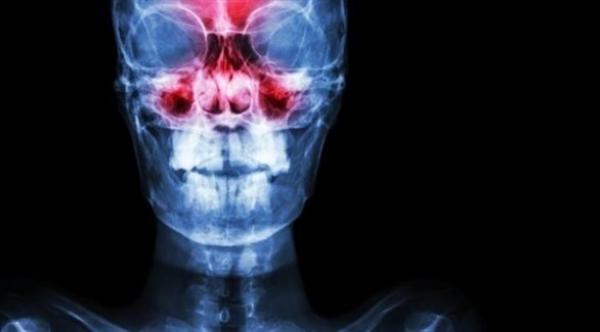 متى تلجأ إلى جراحة الجيوب الأنفية؟