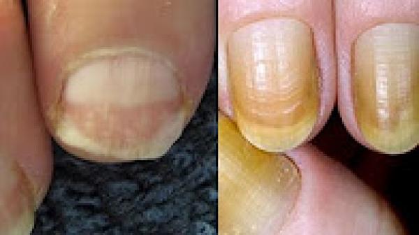 هل تعلم 7 أمراض خطيرة تعرفها من شكل أظافرك !