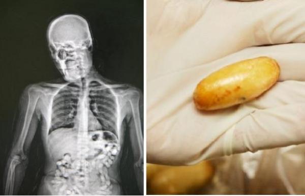 كازا .. تفريغ 75 كبسولة كوكايين من معدة مواطن من ساوتومي