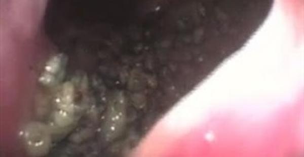 بالفيديو والصور.. العثور على 100 يرقة داخل أنف رجل برازيلي