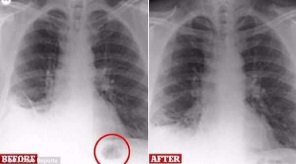 اعتقد الأطباء أنه مصاب بالسرطان.. فعثروا على شيء غريب في رئته