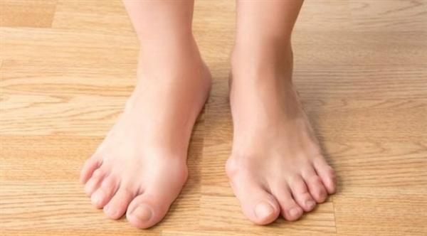 تشوهات القدم...أنواعها وأسبابها