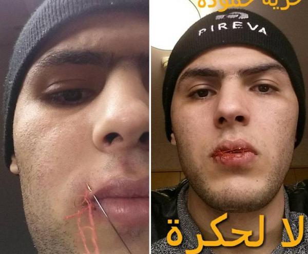 من السويد : شاب مغربي يخيط فمه تضامنا مع "حمودة" فاضح "الزفت المغشوش" (الفيديو )