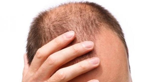 دراسة: الجاذبية سبب الصلع لدى الرجال