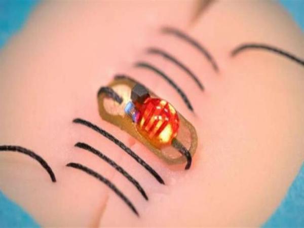 علماء يبتكرون خيوط جراحية "ذكية" تشعر بالالتهاب وتعالجه