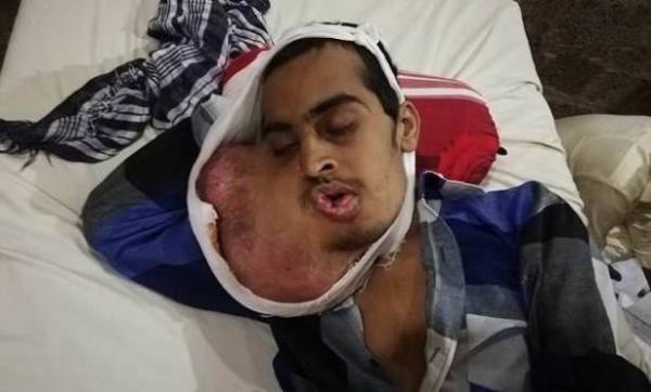 وفّر ثمن زيارة طبيب الاسنان.. والنتيجة سرطان قاتل في الفم!