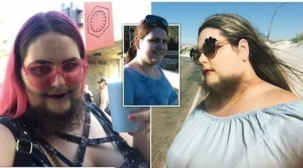 امرأة تعاني من حالة نادرة تسبب لها نمو لحية طويلة