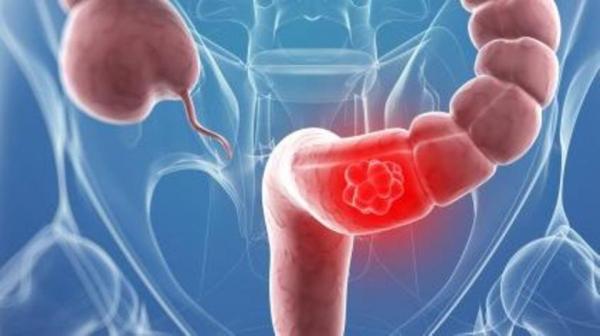 دراسة: معدل الإصابة بسرطان الأمعاء آخذ في الارتفاع بين الشباب الأوروبي