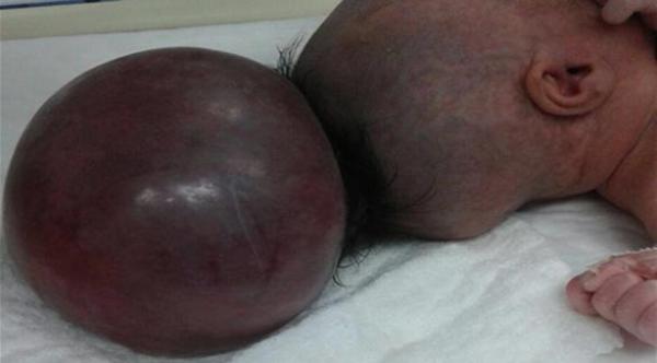 نجاح عملية جراحية لطفلة ولدت بـ "رأس إضافي"