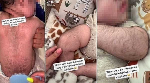 رضيع  يصبح جلده مغطى بالشعر كرجل بالغ بعد تناول دواء عقب ولادته