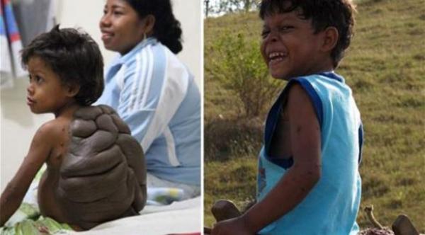 طفل يولد بظهر سلحفاة بسبب ورم نادر