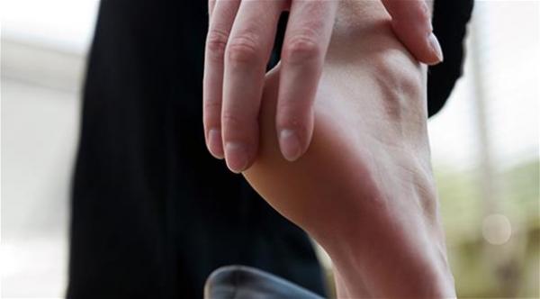 المرأة أكثر عرضة للإصابة بمسمار الكعب