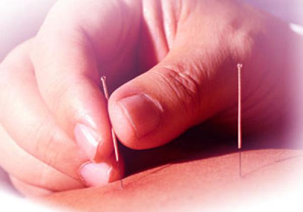العلاج بواسطة الإبر الصينية يساعد فى تخفيف نوبات حساسية الأنف
