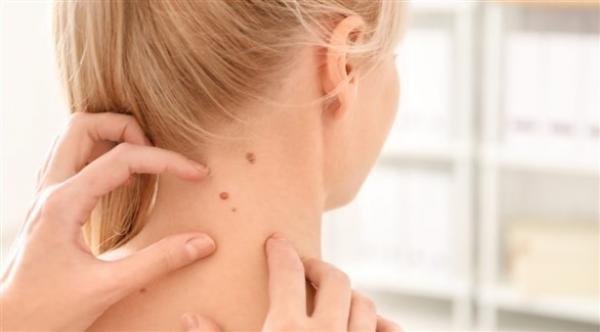 ماهو الفرق بين الشامات الحميدة والخبيثة؟