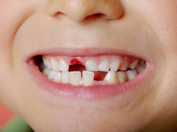 العلماء: يفضل الاحتفاظ بأسنان الأطفال اللبنية بعد سقوطها