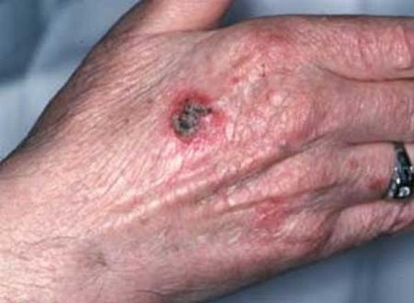 الأطباء يفندون أسطورة العلاقة بين سرطان الجلد والوحمات