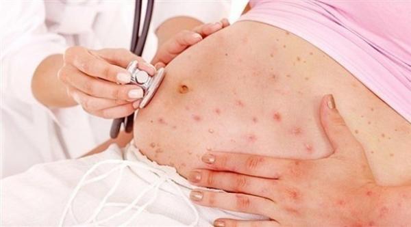 جدري الماء يهدد الجنين بتشوهات خطيرة