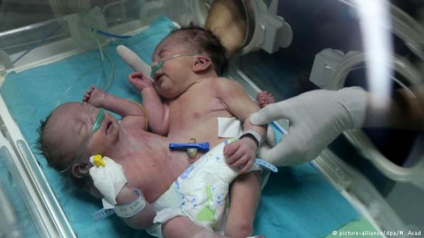 غزة- ولادة توأم سيامي من الإناث