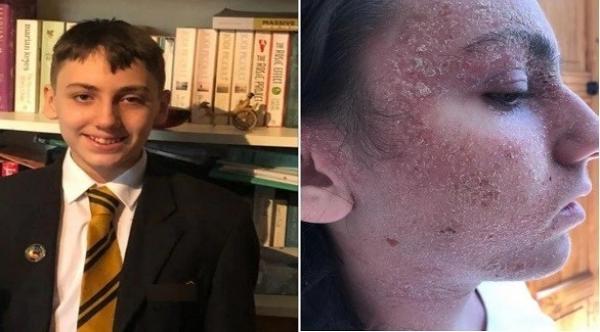 حالة شديدة من الأكزيما تجعل مراهقا يطالب بوضعه في غيبوبة حتى يتخلص من آلامه الشديدة
