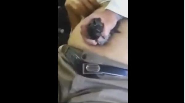 علاج فيروس الكبد بواسطة مؤخرة الحمام