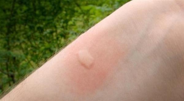 لا تخدش موضع لدغة البعوض