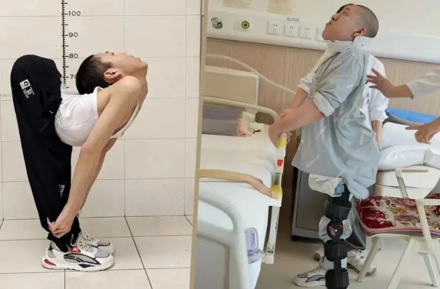 "الطفل ذو الظهر المثني" يُلهم الصين بعد نجاح 4 عمليات أعادت إليه استقامة جسده