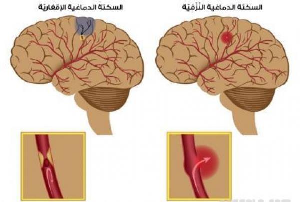 العلامات التحذيرية للسكتة الدماغية