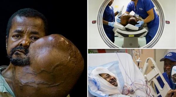 ستيني يعيش بورم وزنه 7 كغم منذ 40 عاماً