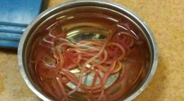 أطباء يزيلون 14 دودة حيّة من بطن مريضة