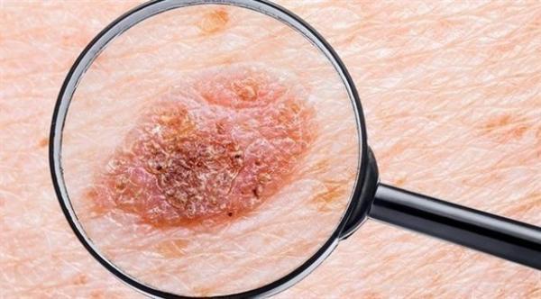 علامات تدل على الإصابة بسرطان الجلد يجب الانتباه إليها