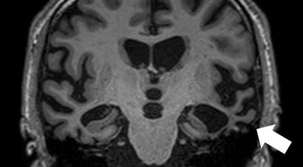 معلومات عن الخرف الجبهي الصدغي