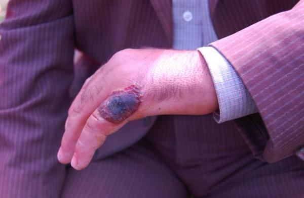 رسميا : وزارة الصحة تكشف عن عدد الإصابات بمرض الجمرة الخبيثة الجلدي بإميلشيل