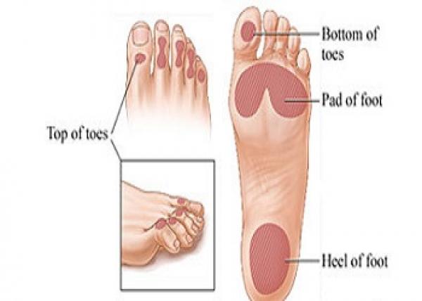 أهم النصائح الطبية لمرضى القدم السكرى أثناء الحج