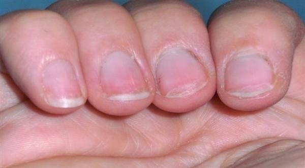 مؤشرات تدل على نقص الفيتامينات ..تعرف عليها