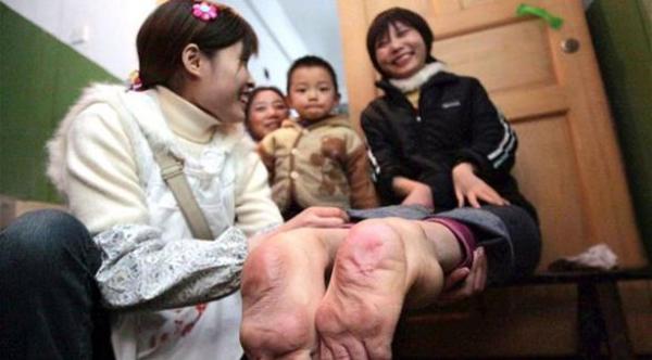 سبحان الله .. صينية وُلدت بقدمين مقلوبتين