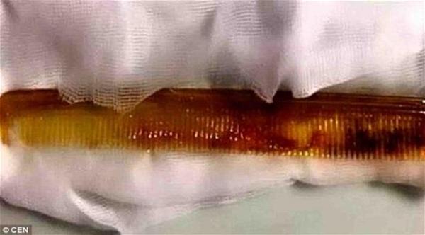 تركية تبتلع مشطاً استخدمته لدفع حبة الدواء إلى معدتها