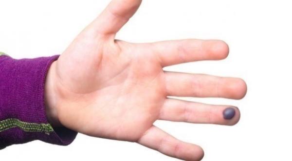 ما هو احتباس الدم ومتى يتطلب رؤية الطبيب؟