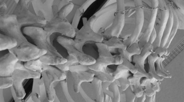 خبراء للمرضى: لا تتسرعوا بإجراء جراحات العمود الفقري